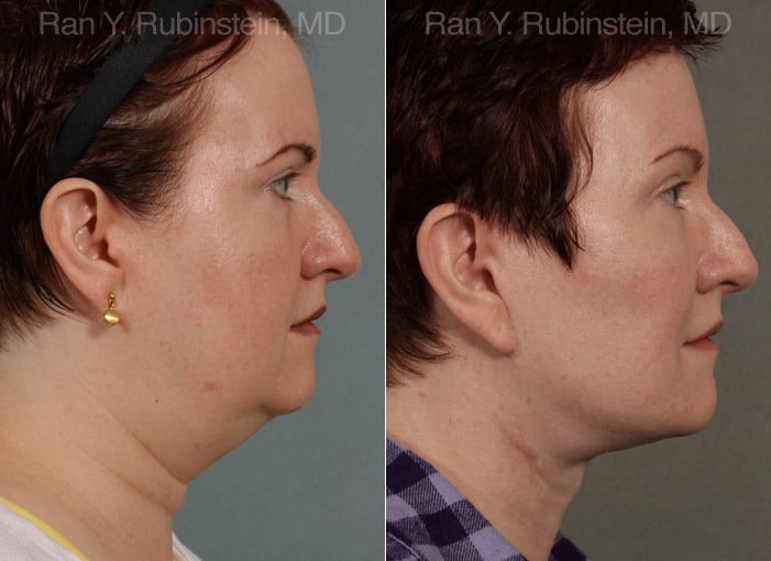 Face lift & Neck lift Before and After Photos in Newburgh, NY, Patient 12636