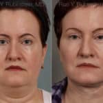 Face lift & Neck lift Before and After Photos in Montvale, NJ, Patient 12636