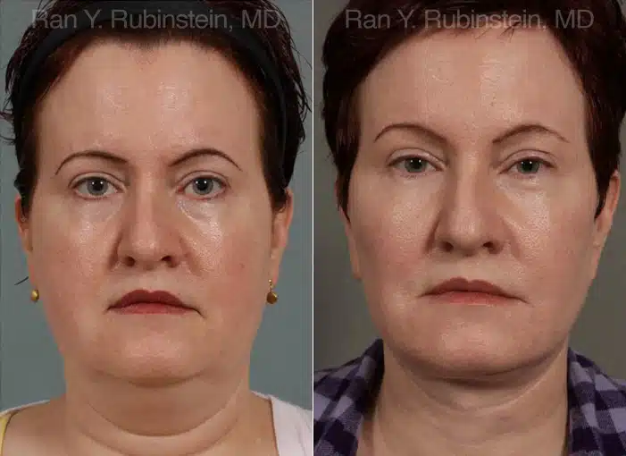 Face lift & Neck lift Before and After Photos in Newburgh, NY, Patient 12636