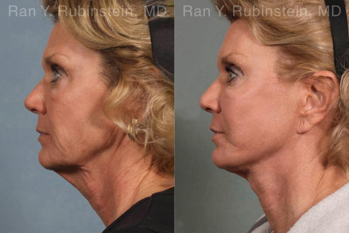 Face lift & Neck lift Before and After Photos in Newburgh, NY, Patient 12648