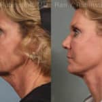 Face lift & Neck lift Before and After Photos in Newburgh, NY, Patient 12648