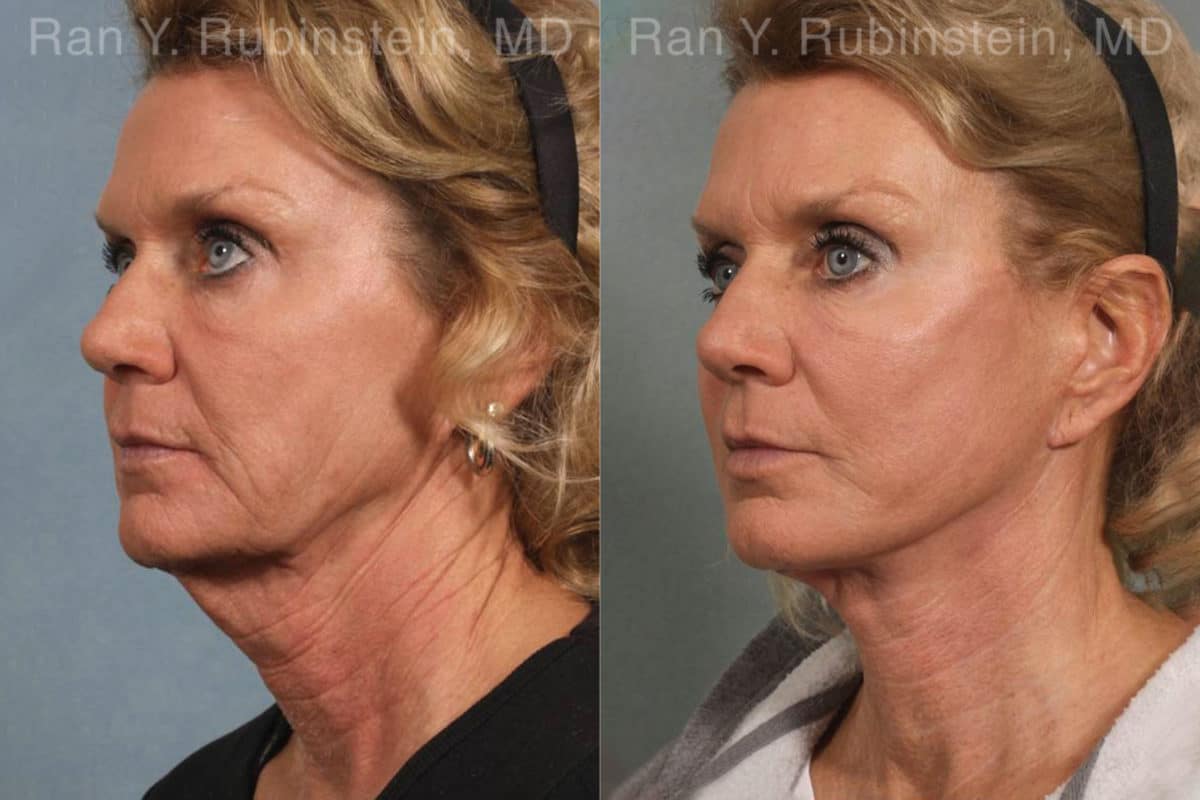 Face lift & Neck lift Before and After Photos in Newburgh, NY, Patient 12648