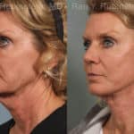 Face lift & Neck lift Before and After Photos in Newburgh, NY, Patient 12648