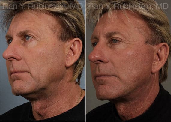 Face lift & Neck lift Before and After Photos in Newburgh, NY, Patient 12668