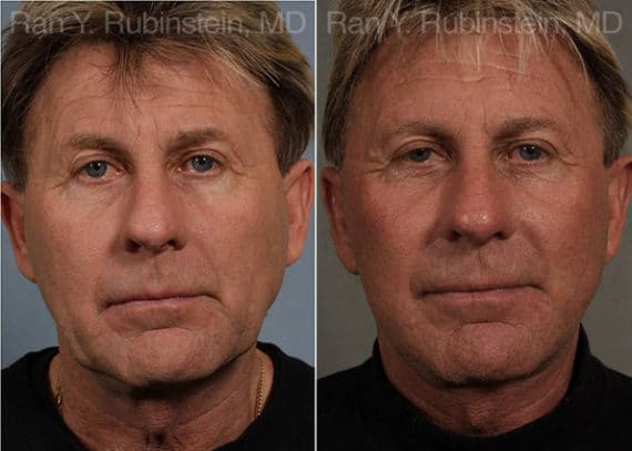 Face lift & Neck lift Before and After Photos in Newburgh, NY, Patient 12668