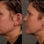 Face lift & Neck lift Before and After Photos in Newburgh, NY, Patient 12681