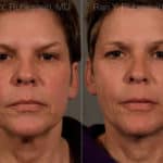 Face lift & Neck lift Before and After Photos in Newburgh, NY, Patient 12681