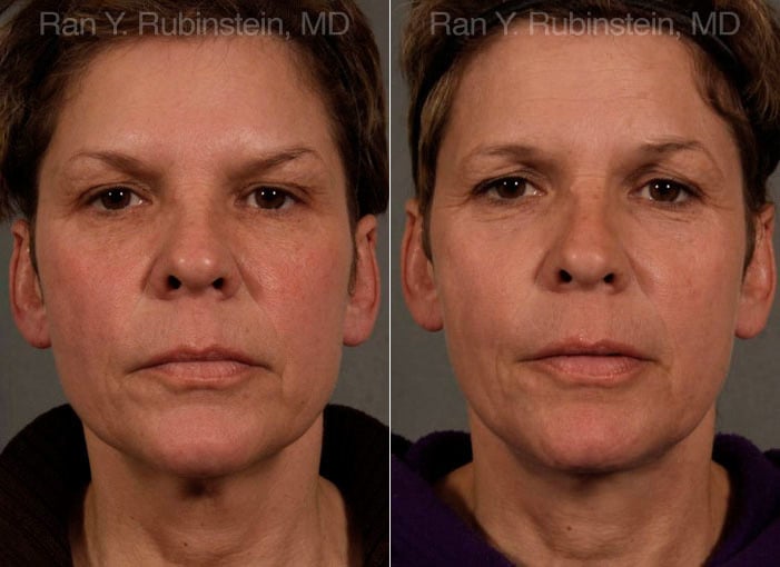 Face lift & Neck lift Before and After Photos in Newburgh, NY, Patient 12681