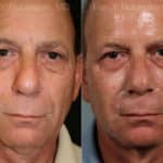 Sculptra Face Before and After Photos in Newburgh, NY, Patient 12776