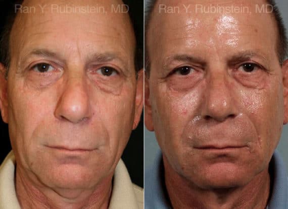 Sculptra Face Before and After Photos in Newburgh, NY, Patient 12776