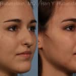 Rhinoplasty Before and After Photos in Newburgh, NY, Patient 13142