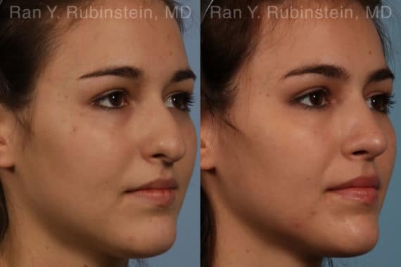 Rhinoplasty Before and After Photos in Newburgh, NY, Patient 13142