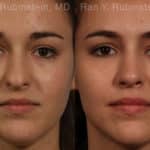 Rhinoplasty Before and After Photos in Newburgh, NY, Patient 13142