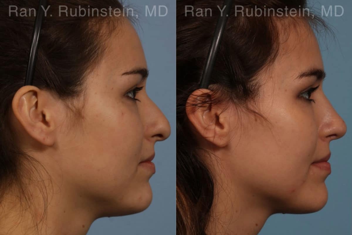 Rhinoplasty Before and After Photos in Newburgh, NY, Patient 13142