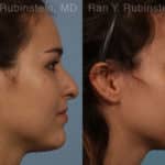 Rhinoplasty Before and After Photos in Newburgh, NY, Patient 13142