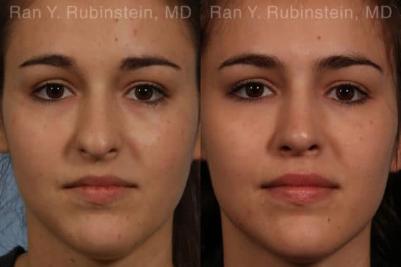 Rhinoplasty Before and After Photos in Newburgh, NY, Patient 13142