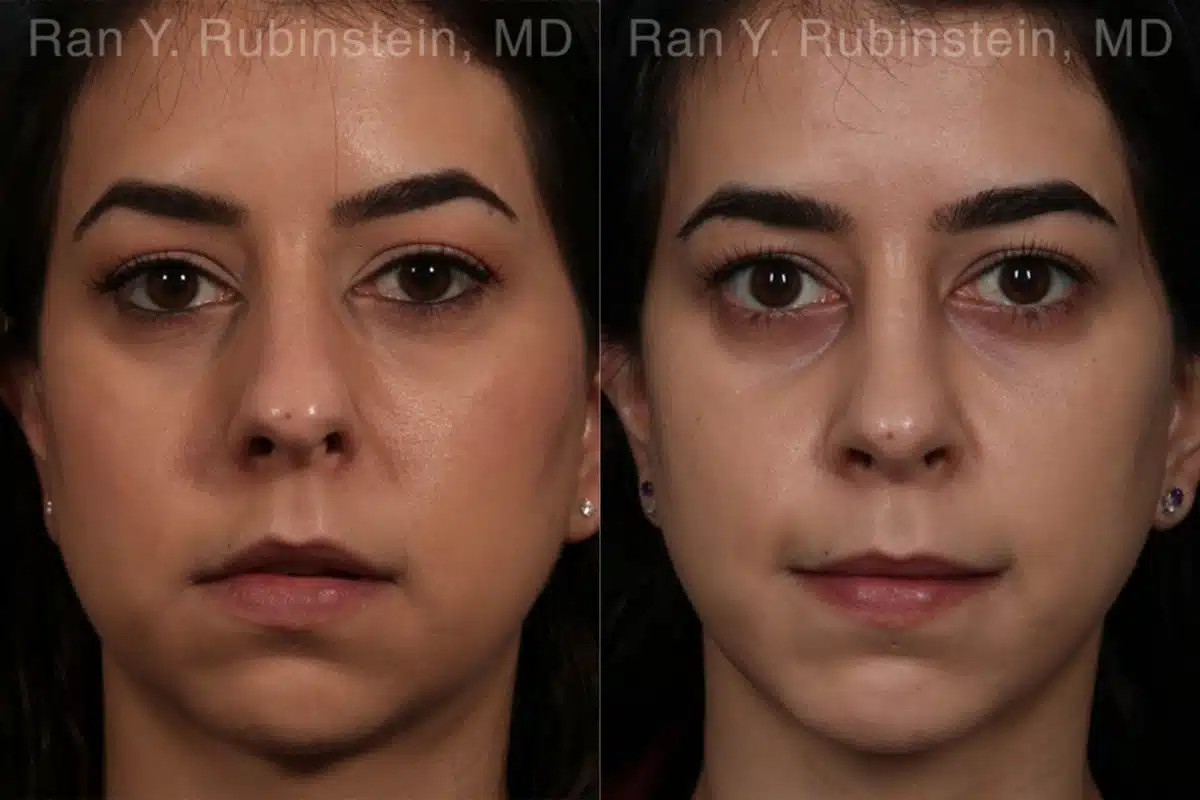 Rhinoplasty Before and After Photos in Newburgh, NY, Patient 13147