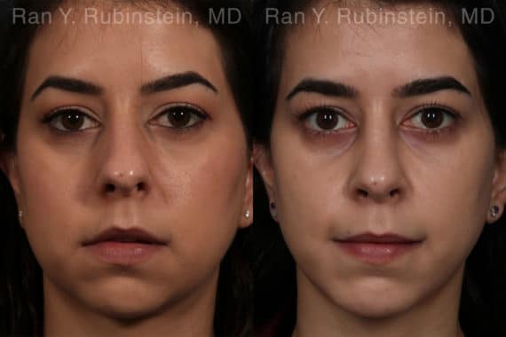 Rhinoplasty Before and After Photos in Newburgh, NY, Patient 13147