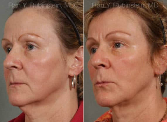 Laser Lift Precision Tx Before and After Photos in Newburgh, NY, Patient 13265