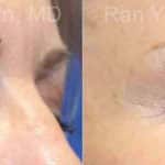 Microneedling RF Before and After Photos in Newburgh, NY, Patient 16590