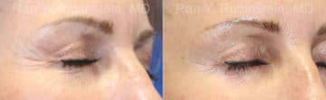 Microneedling RF Before and After Photos in Newburgh, NY, Patient 16590