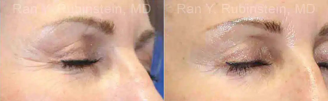 Microneedling RF Before and After Photos in Newburgh, NY, Patient 16590