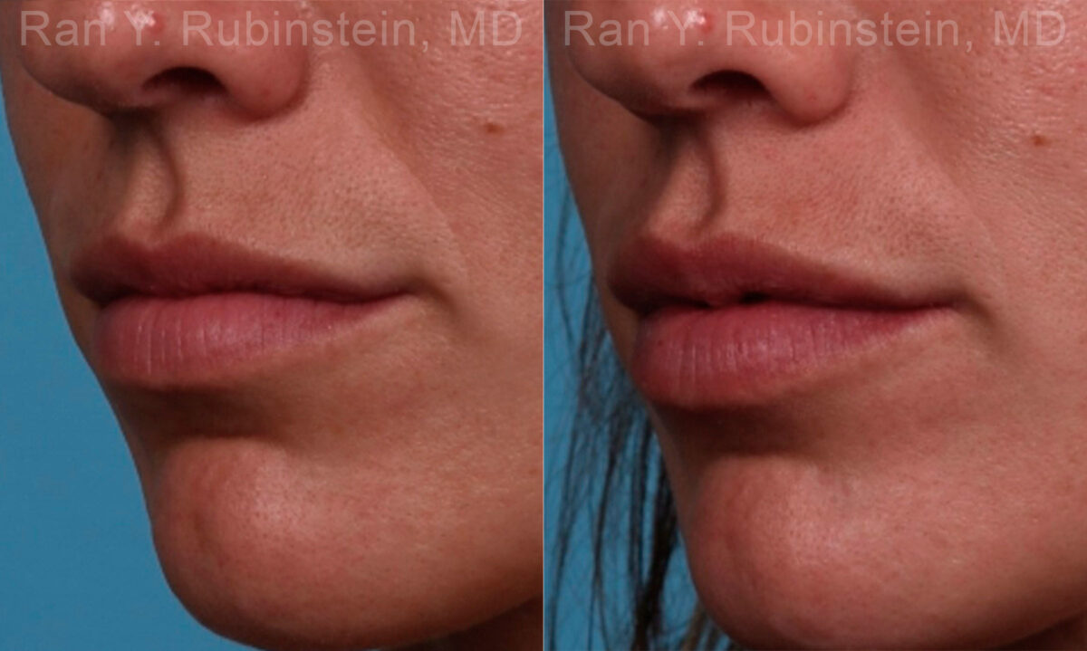 Lip Fillers Before and After Photos in Newburgh, NY, Patient 17216