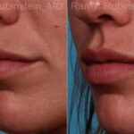 Lip Fillers Before and After Photos in Newburgh, NY, Patient 17216