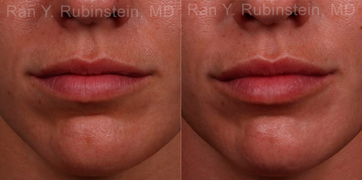 Lip Fillers Before and After Photos in Newburgh, NY, Patient 17216