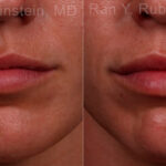 Lip Fillers Before and After Photos in Newburgh, NY, Patient 17216