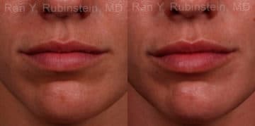 Lip Fillers Before and After Photos in Newburgh, NY, Patient 17216