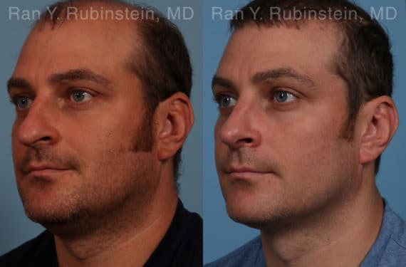 Rhinoplasty Before and After Photos in Newburgh, NY, Patient 17247