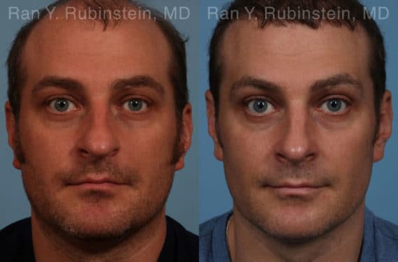 Rhinoplasty Before and After Photos in Newburgh, NY, Patient 17247