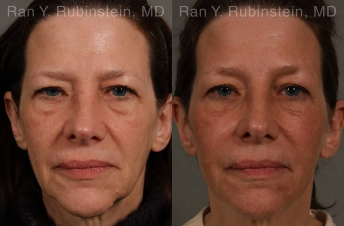 Dermal Fillers Before and After Photos in Newburgh, NY, Patient 17263