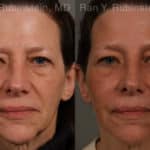 Dermal Fillers Before and After Photos in Newburgh, NY, Patient 17263