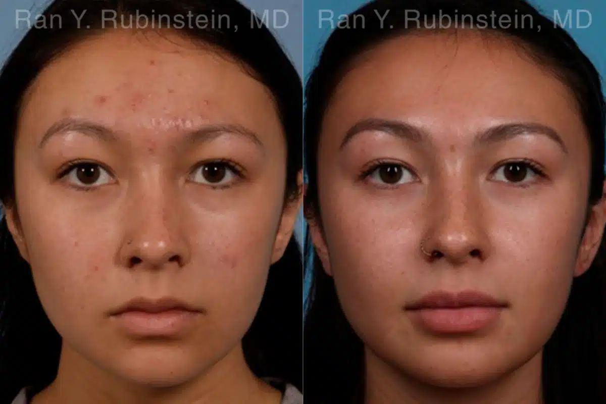 Laser Treatments Before and After Photos in Newburgh, NY, Patient 17406