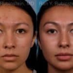 Laser Treatments Before and After Photos in Newburgh, NY, Patient 17406