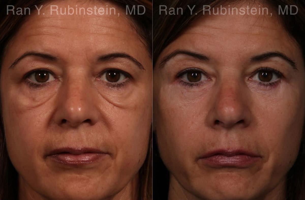 Eyelid Surgery Before and After Photos in Newburgh, NY, Patient 17657