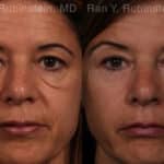 Eyelid Surgery Before and After Photos in Newburgh, NY, Patient 17657