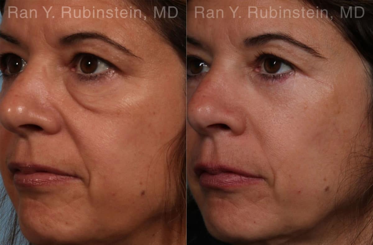 Eyelid Surgery Before and After Photos in Newburgh, NY, Patient 17657