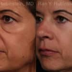 Eyelid Surgery Before and After Photos in Newburgh, NY, Patient 17657