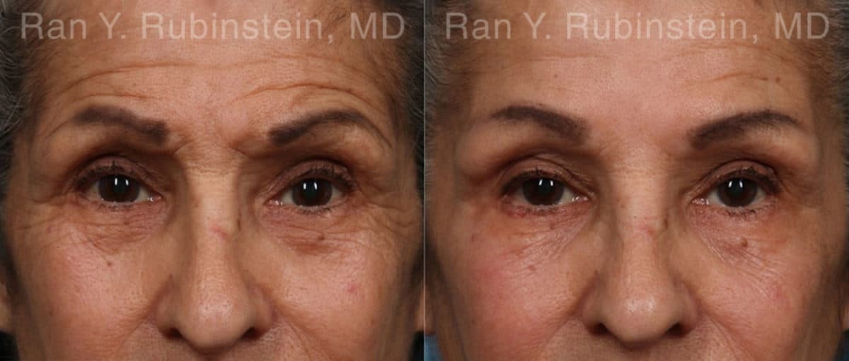 Botox Before and After Photos in Newburgh, NY, Patient 17907