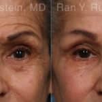 Botox Before and After Photos in Newburgh, NY, Patient 17907