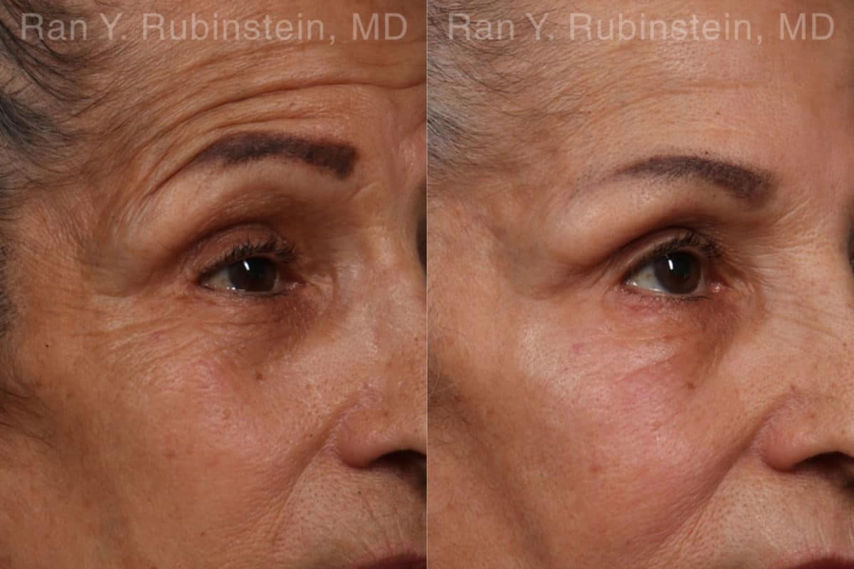 Botox Before and After Photos in Newburgh, NY, Patient 17907