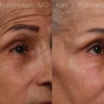 Botox Before and After Photos in Newburgh, NY, Patient 17907