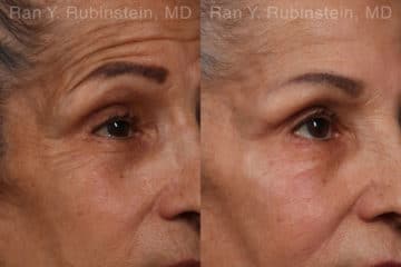 Botox Before and After Photos in Newburgh, NY, Patient 17907