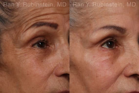 Botox Before and After Photos in Newburgh, NY, Patient 17907