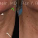 Botox Before and After Photos in Newburgh, NY, Patient 17908