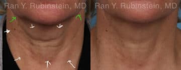 Botox Before and After Photos in Newburgh, NY, Patient 17908