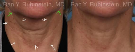 Botox Before and After Photos in Newburgh, NY, Patient 17908